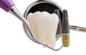 Dental implants