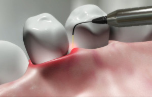 Laser treatment