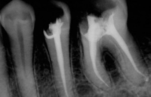 Root Canals
